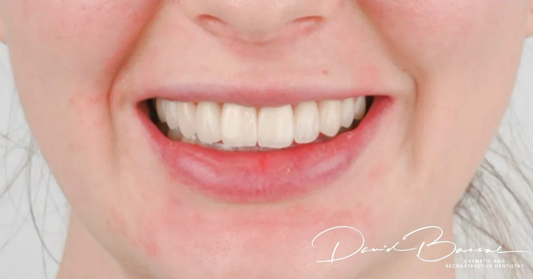 Veneers- are they right for you?