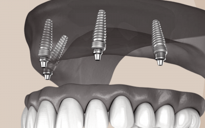 Teeth on Implants – Frequently Asked Questions with Dr David Bassal