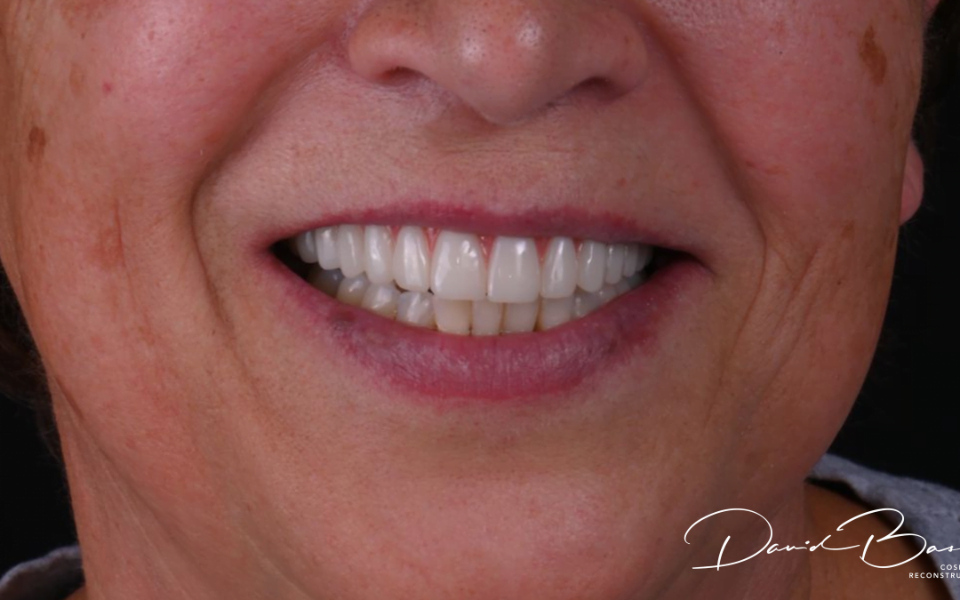8 Questions to Ask Before Having Cosmetic Dentistry
